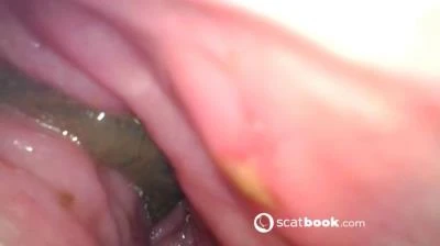 Endoscope In My Ass [FullHD 1080p] 647 MB